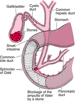 gallstone-pancreatitis