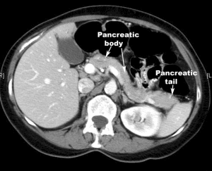 Pancreatic Regeneration: What IF The Human Pancreas Can Regenerate ...