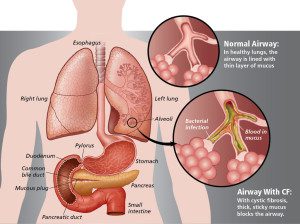 cystic-fibrosis-chronic-pancreas-inflammation