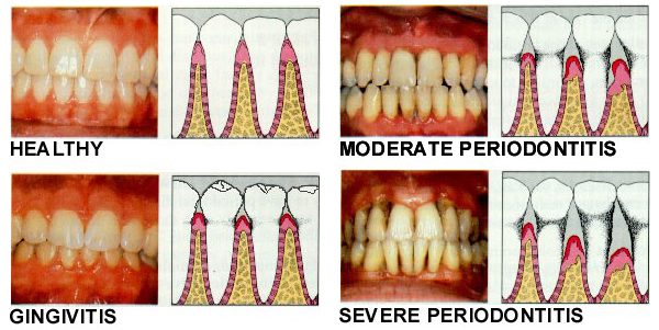 periodontal disease